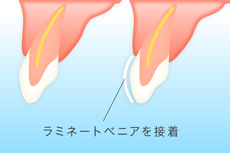 【ラミネートべニア】歯の表面に人工歯を貼り付ける治療法