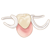 見た目が入れ歯と分かりにくい【ノンクラスプデンチャー】