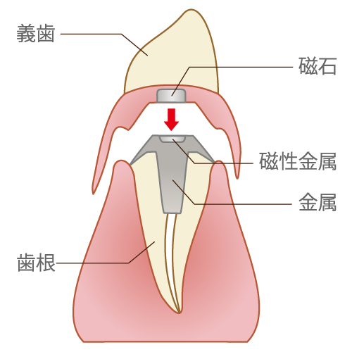 磁性アタッチメント （維持装置）